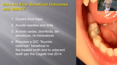 Screenshot from Managing Caries webinar