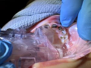 The inside of a child's mouth with caries