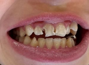 Pediatric patient with caries