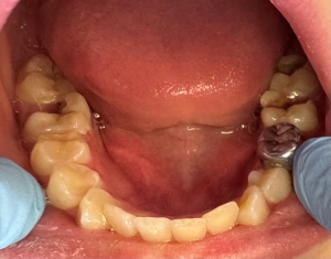 Crown on Robertson's patient's tooth