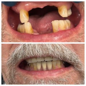 A veteran's teeth before and after going to D4V for dental care