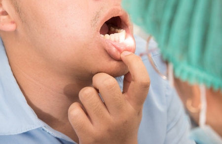 HPV sore