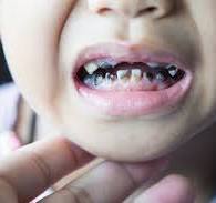 Child with extensive tooth decay