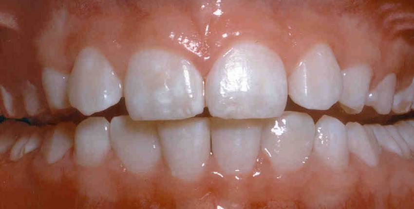 Image of mild dental fluorosis