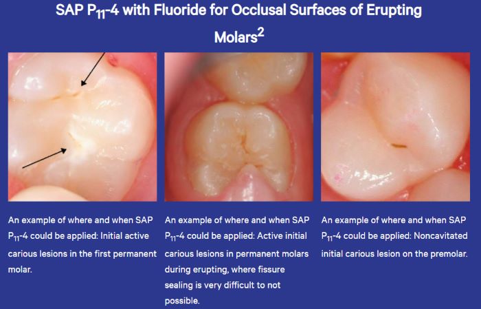 "SAP P11-4 Examples"