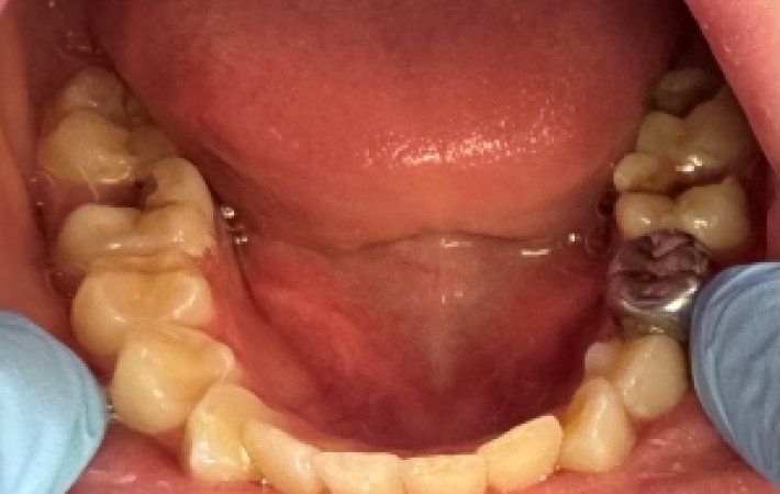 Crown on Robertson's patient's tooth