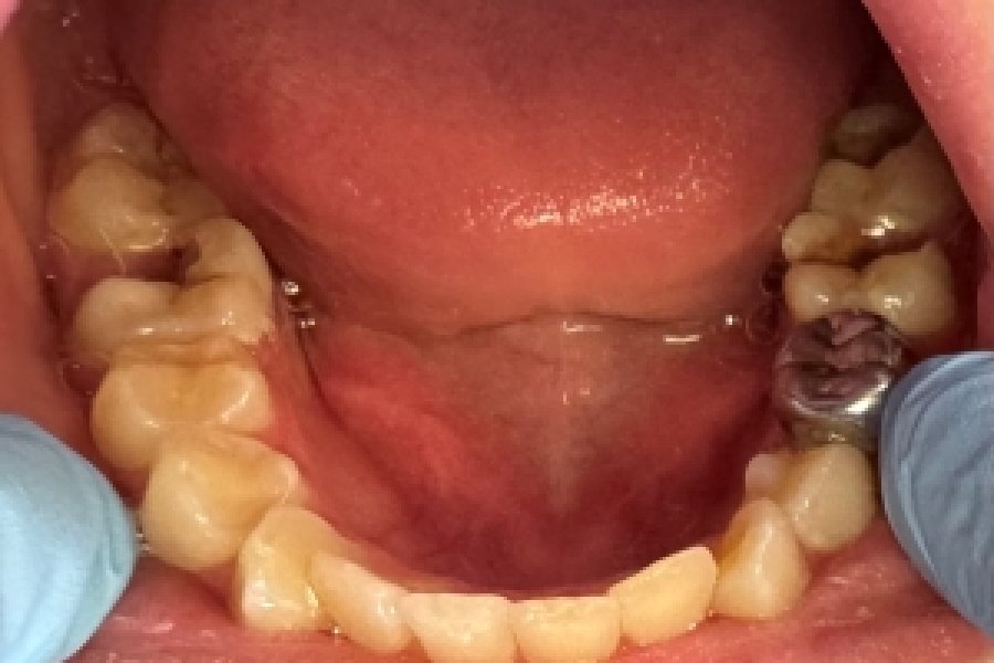 Crown on Robertson's patient's tooth